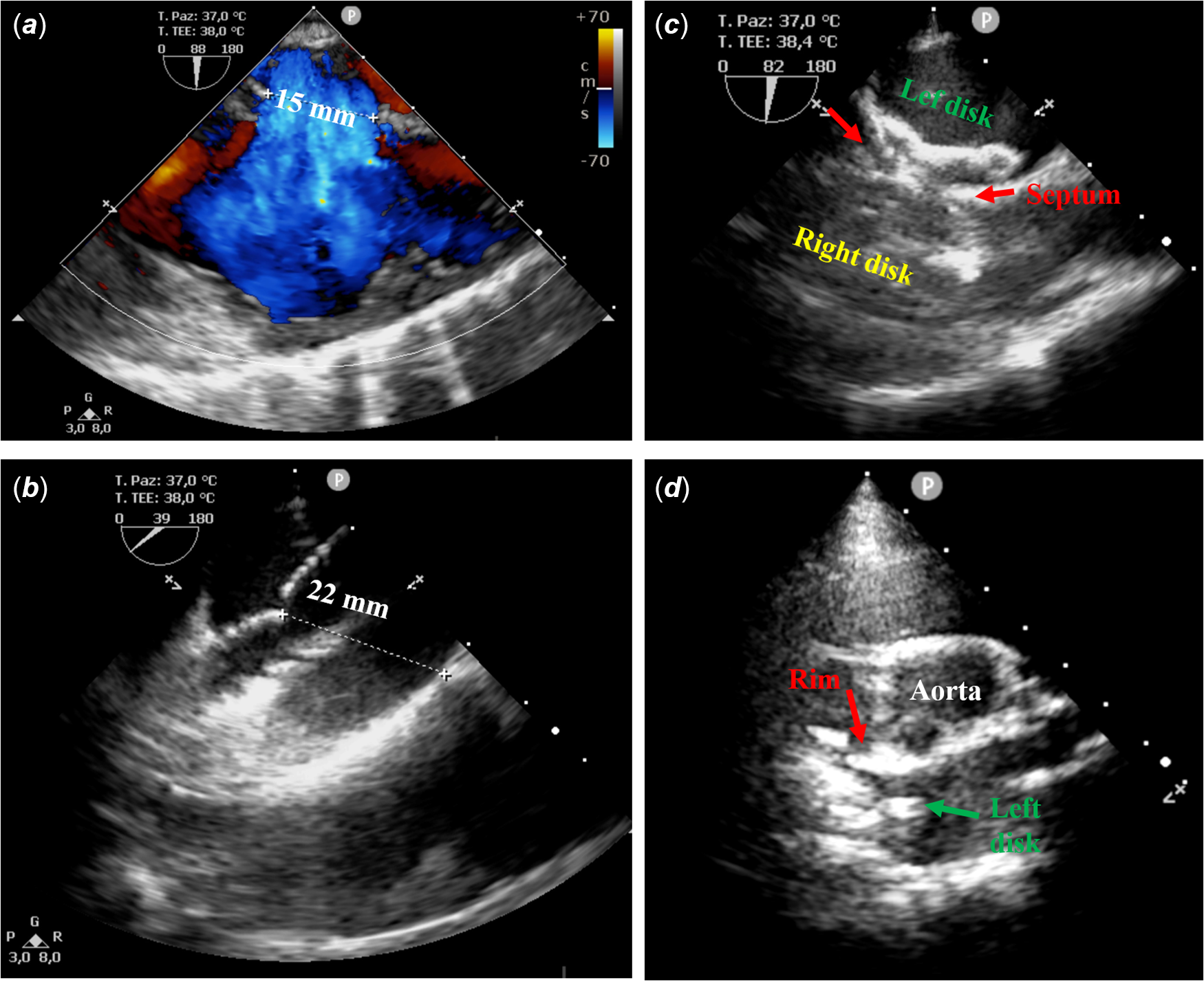 Severe scoliosis and percutaneous atrial septal defect closure, a word ...