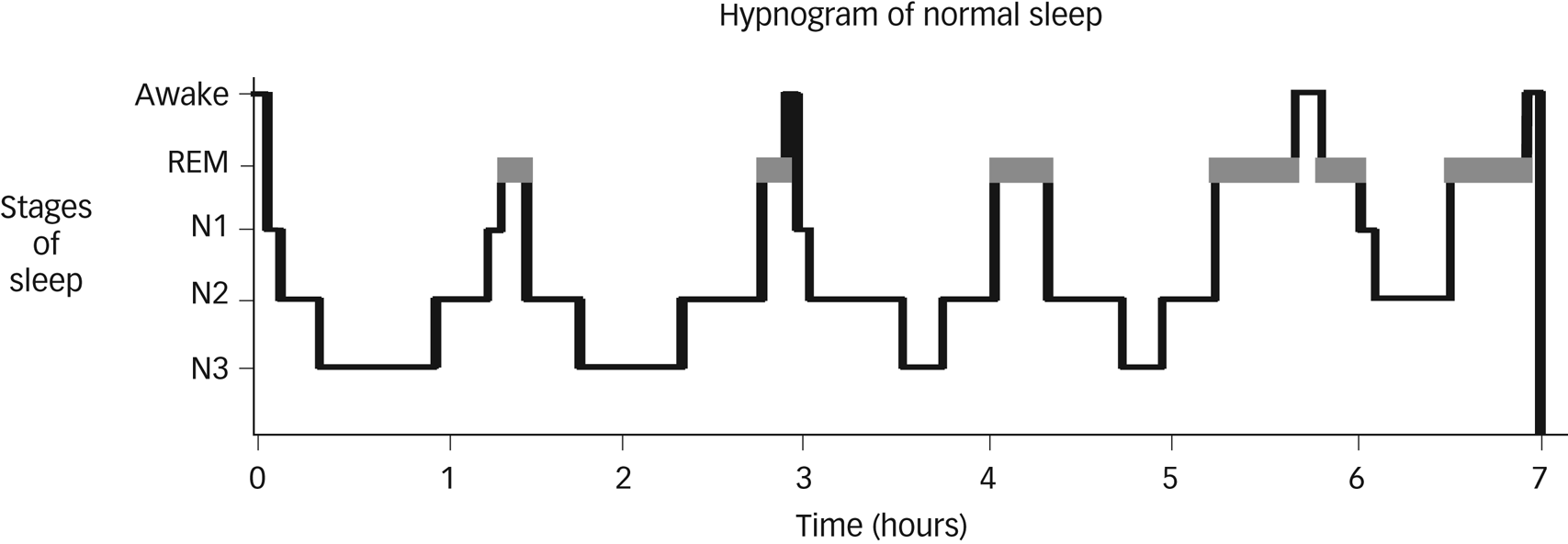 The Relationship Between Sleep And Depression And Bipolar Disorder In ...