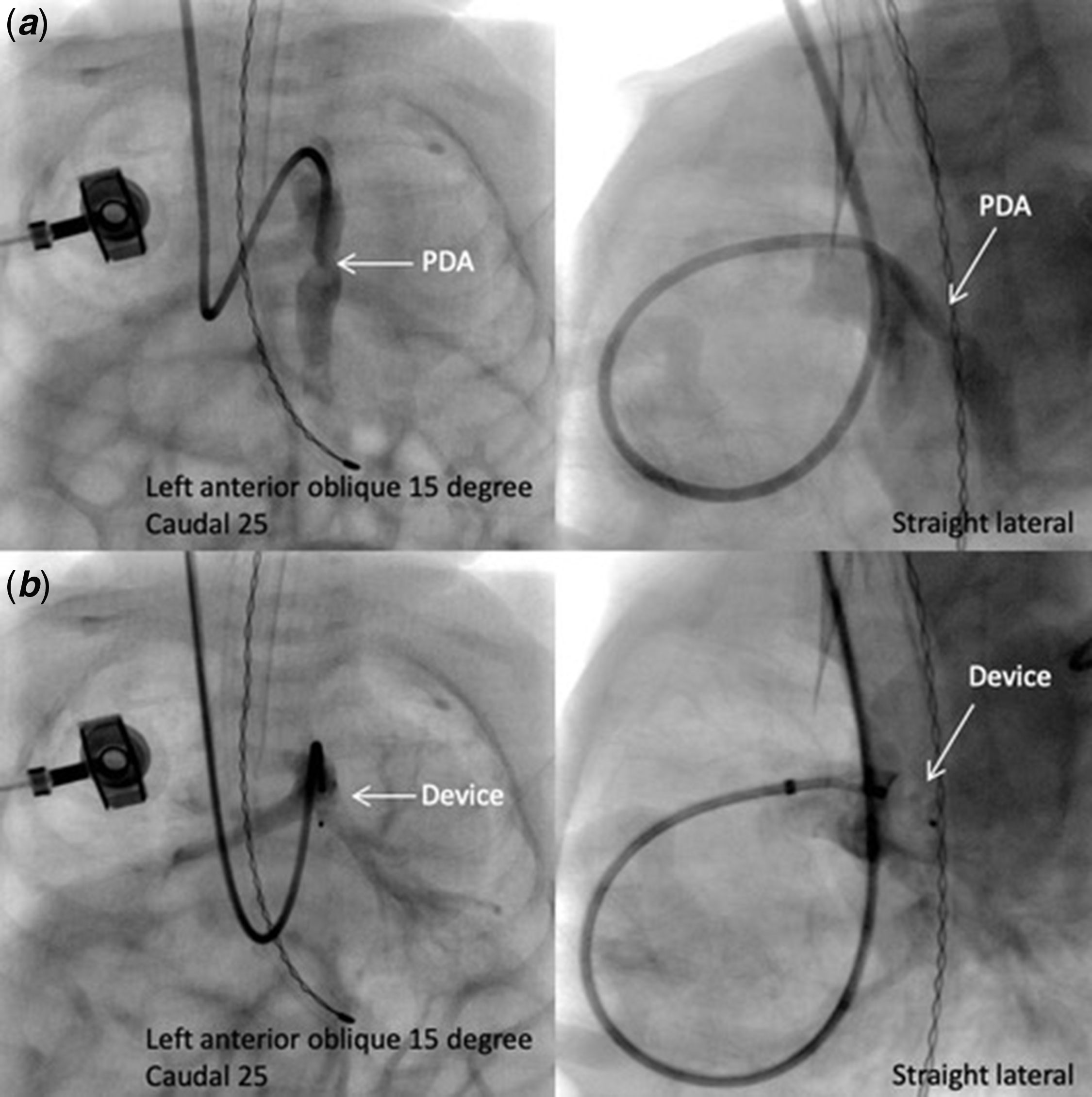 TCT 201: Assessment of LV Dysfunction and its Predictors Following Catheter  Guided Patent Ductus Arteriosus Device Closure