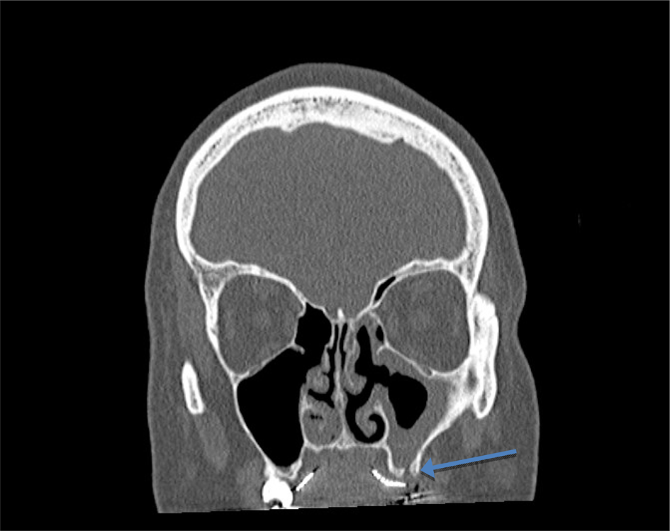 Odontogenic Sinusitis Case Series And Review Of Literature The