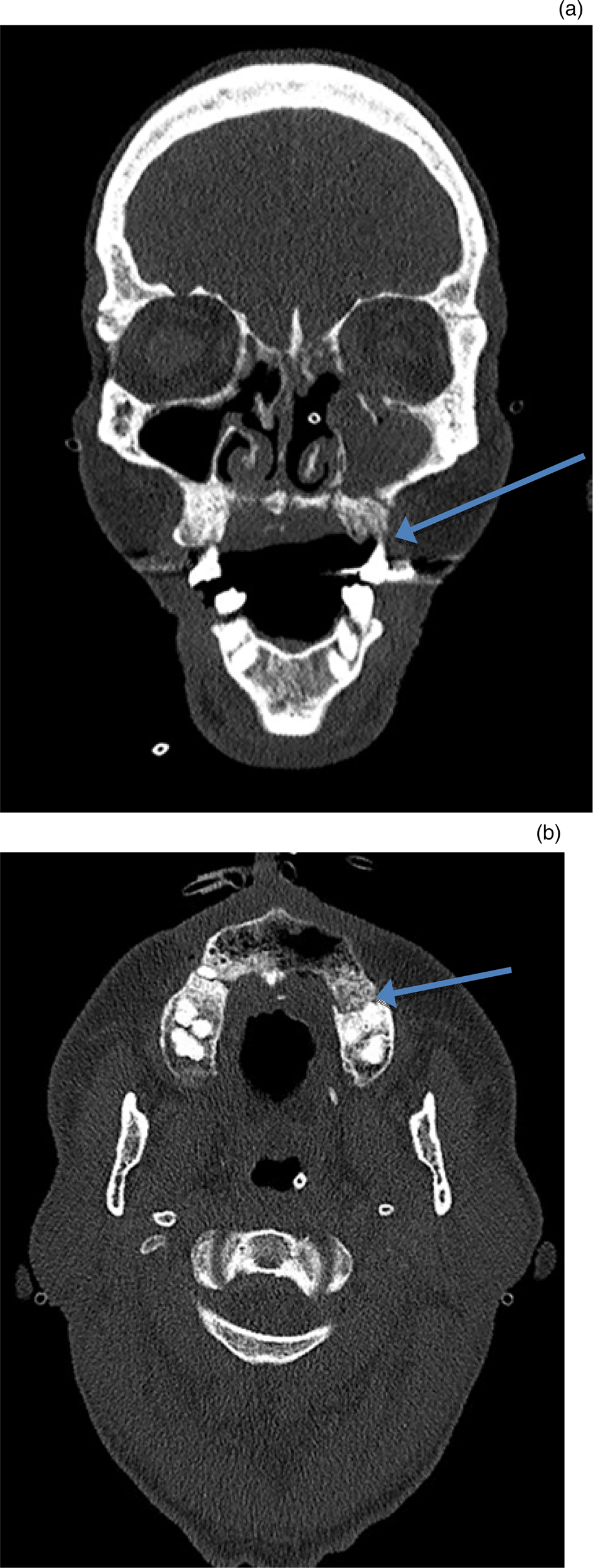 Odontogenic Sinusitis Case Series And Review Of Literature The