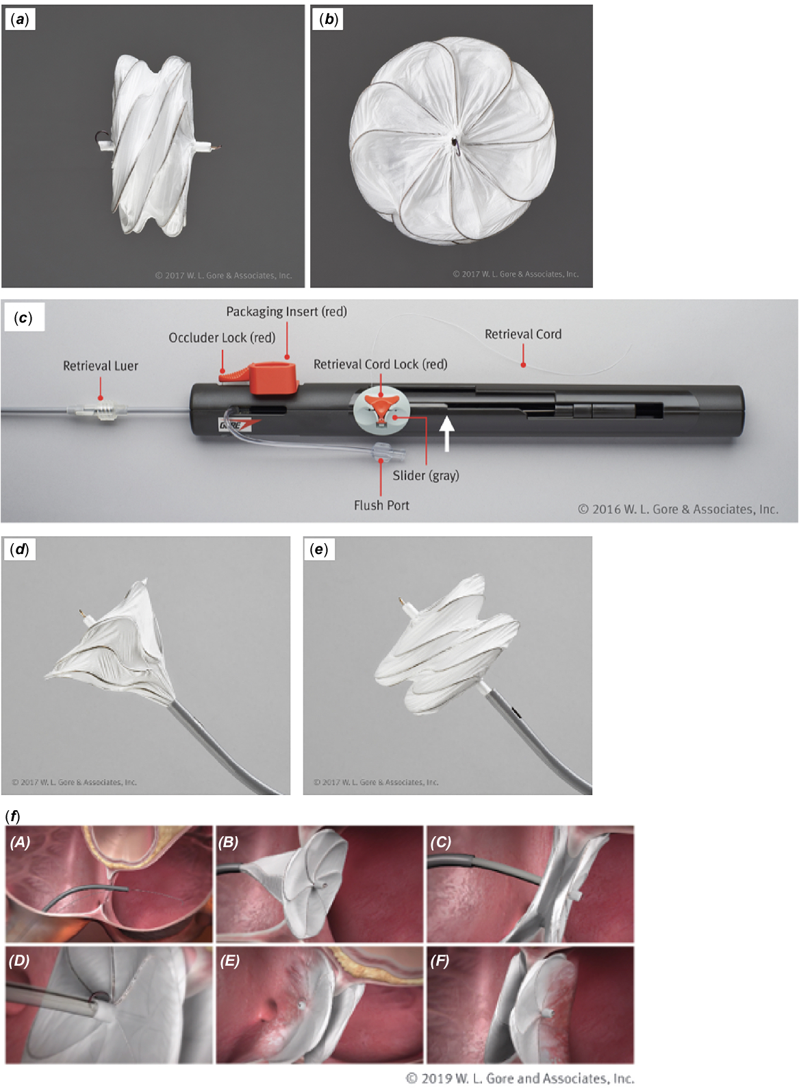 Gore Cardioform Atrial Septal Occluder: Deployment Procedure And ...