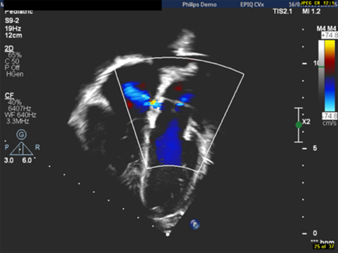 Transoesophageal echocardiography-guided hybrid balloon valvuloplasty for  severe pulmonic stenosis in small dogs