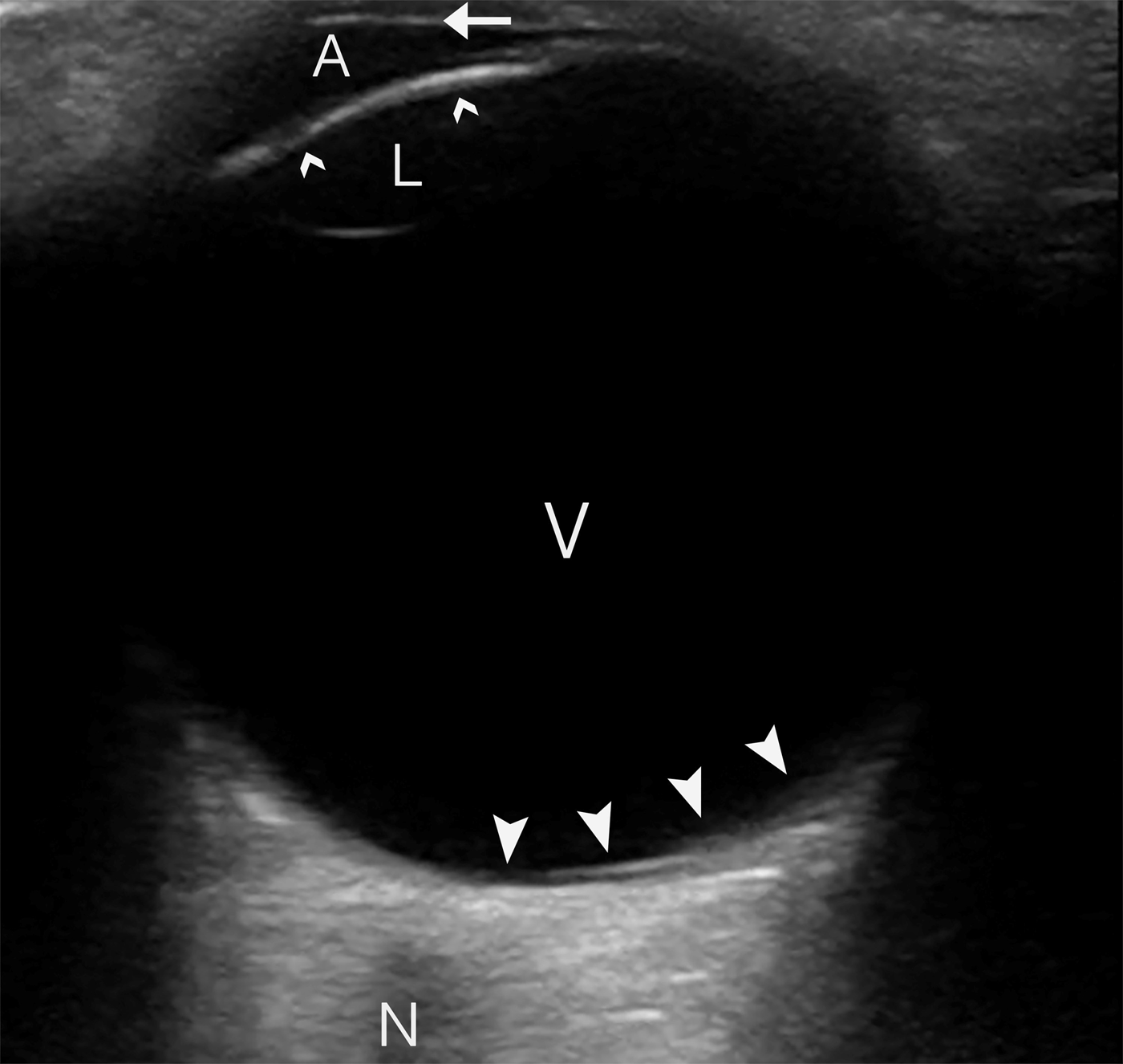 Emergency department point-of-care ultrasound diagnosis of submacular  hemorrhage presenting as painless loss of vision | Canadian Journal of  Emergency Medicine | Cambridge Core