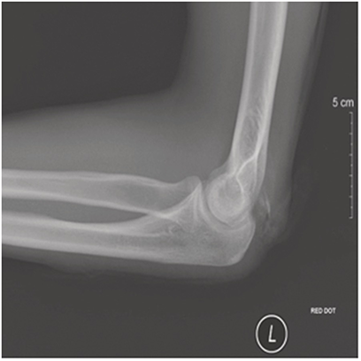 japanese amateur 3 thumb fractures