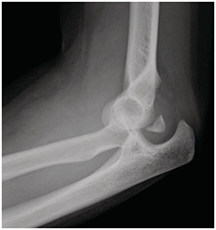Brace Align Rotator cuff repair, elbow injury, Argentina