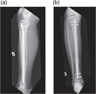 Mal-union in Femoral Fracture Treated by Titanium Elastic nailing  Department of Orthopaedics, College of Medicine, Chung-Ang University,  Seoul, Korea Ho-Joong. - ppt download