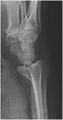 Figure, Posterior Short Leg Splint. Frontal] - StatPearls