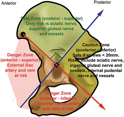 Hip Pain (Severe) - 2 X QF28-6, 1 X QF28-3