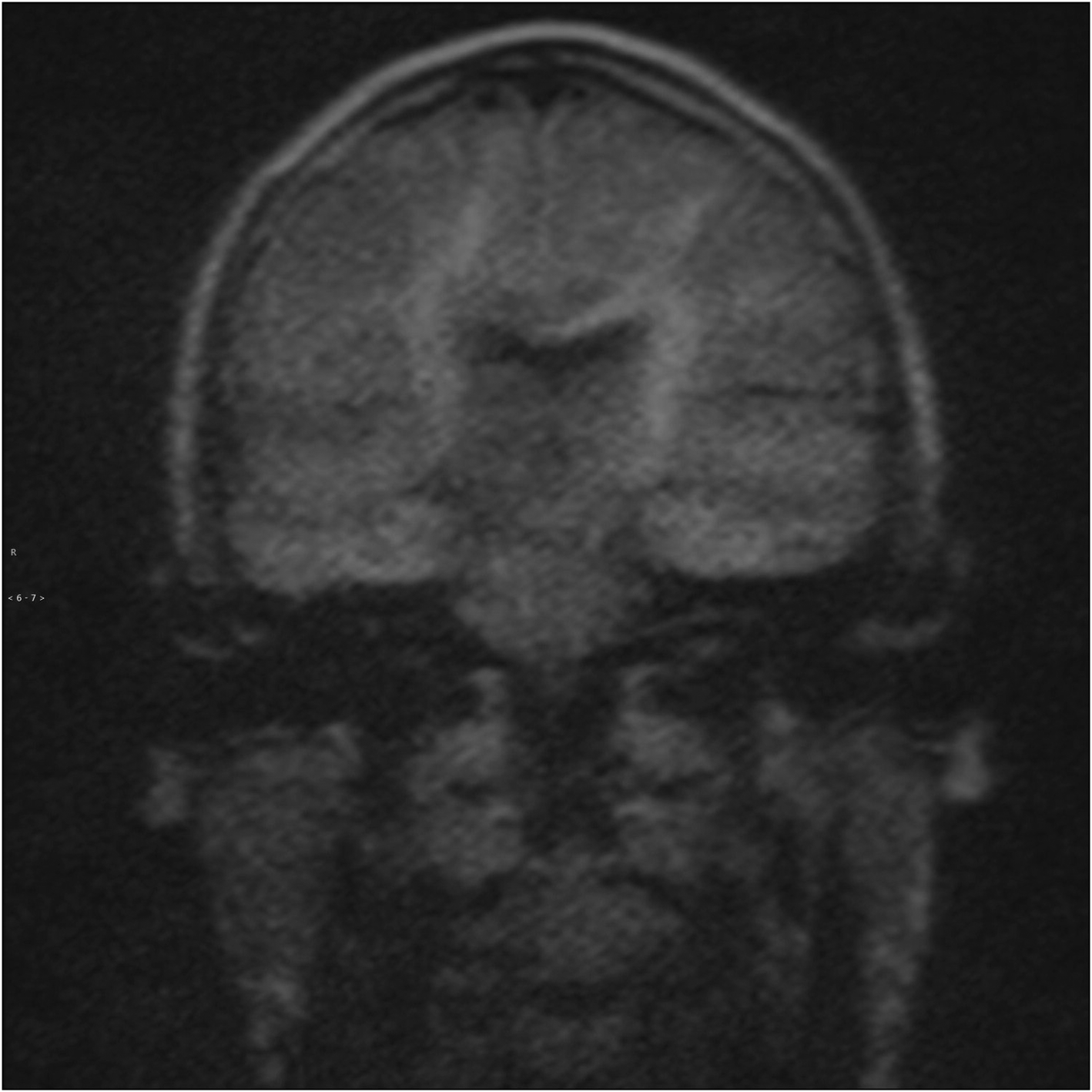 Magnetic resonance non-echo planar diffusion-weighted imaging accuracy ...