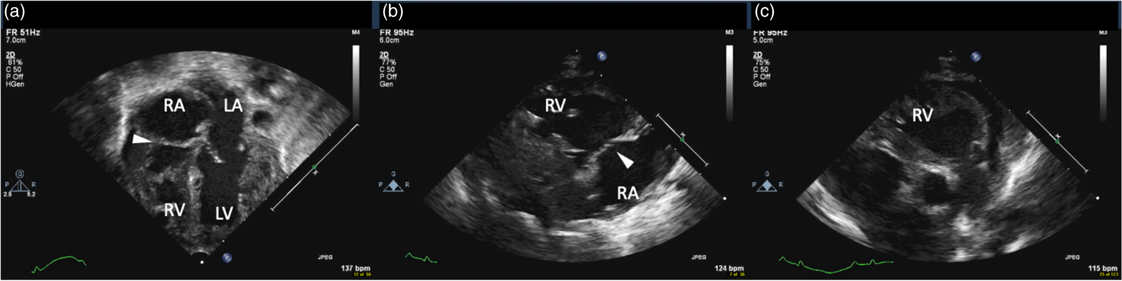 An echocardiographic finding mimicking tricuspid atresia in a neonate ...