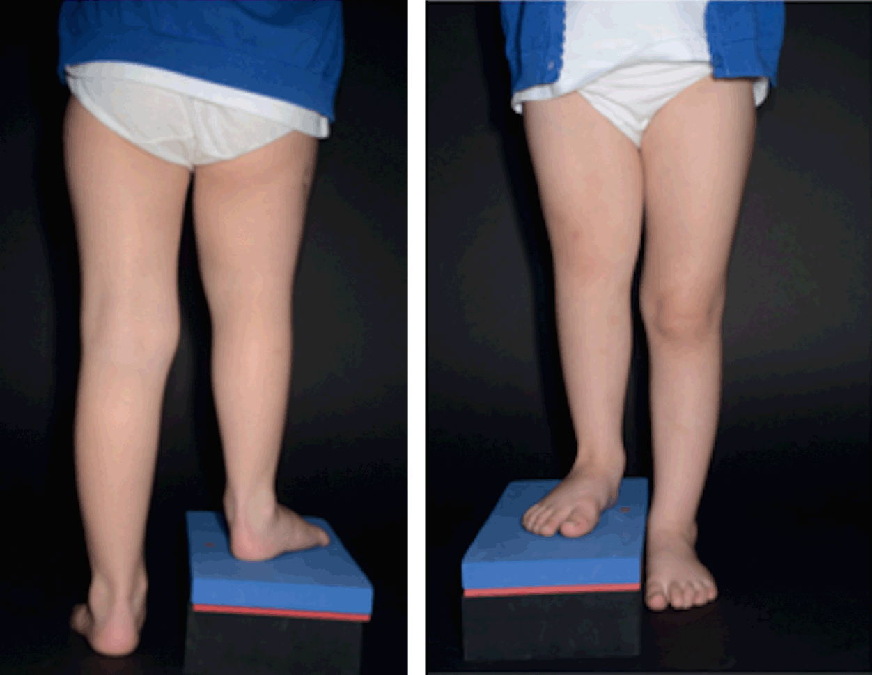 A CASE OF UNILATERAL TIBIAL HEMIMELIA WITH UNILATERAL RADIAL CLUB