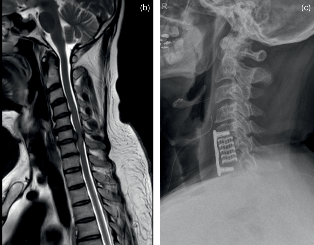 Iliopsoas Syndrome - Orthopaedic Spine Surgery Singapore