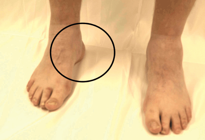 The Flat Foot - Cambridge Foot and Ankle Clinic