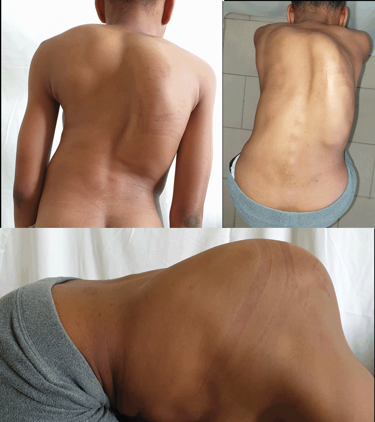 Post Surgery Arm and Shoulder Liposuction Algeria