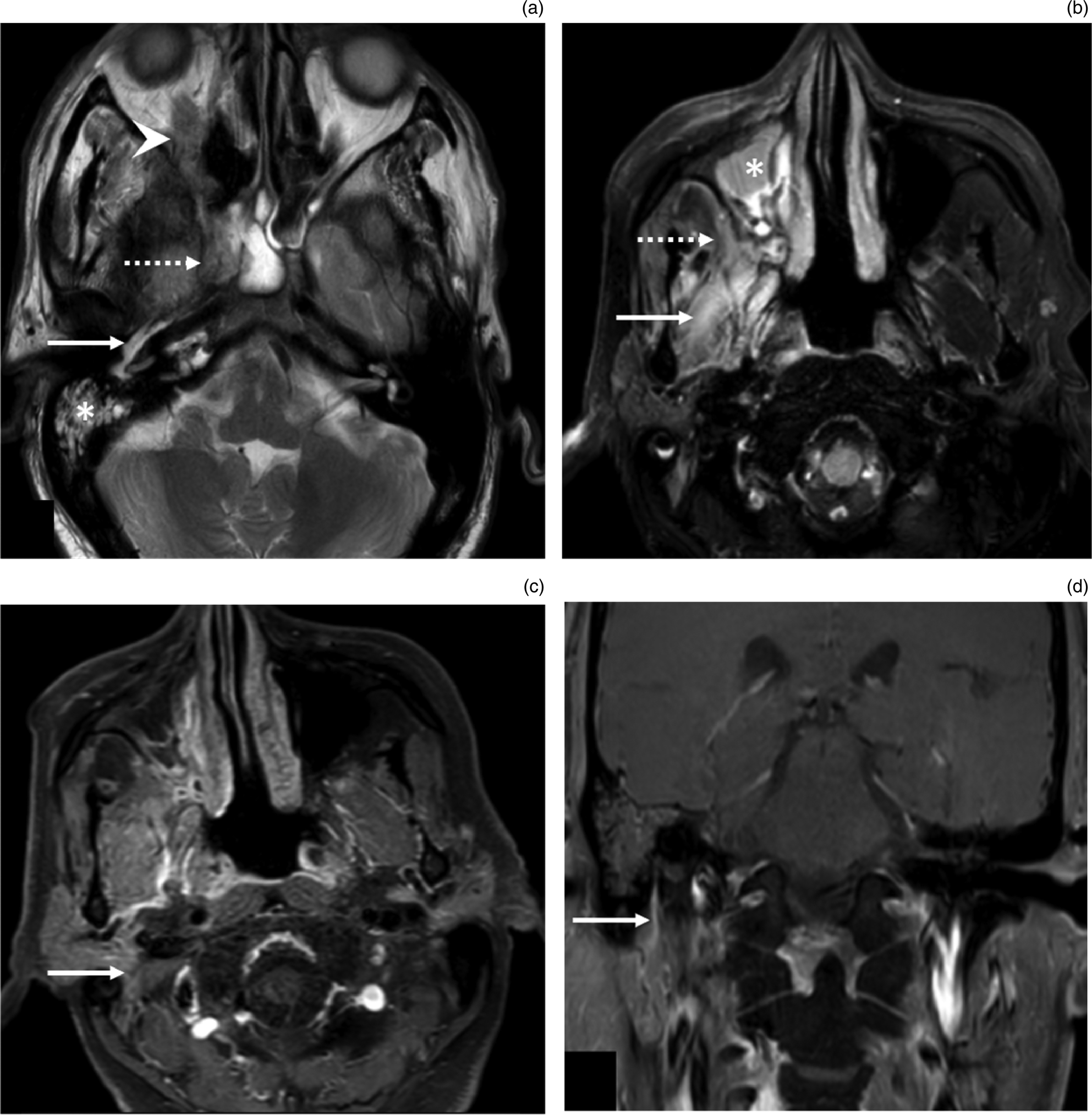 Facial neuritis in coronavirus disease 2019 associated mucormycosis ...