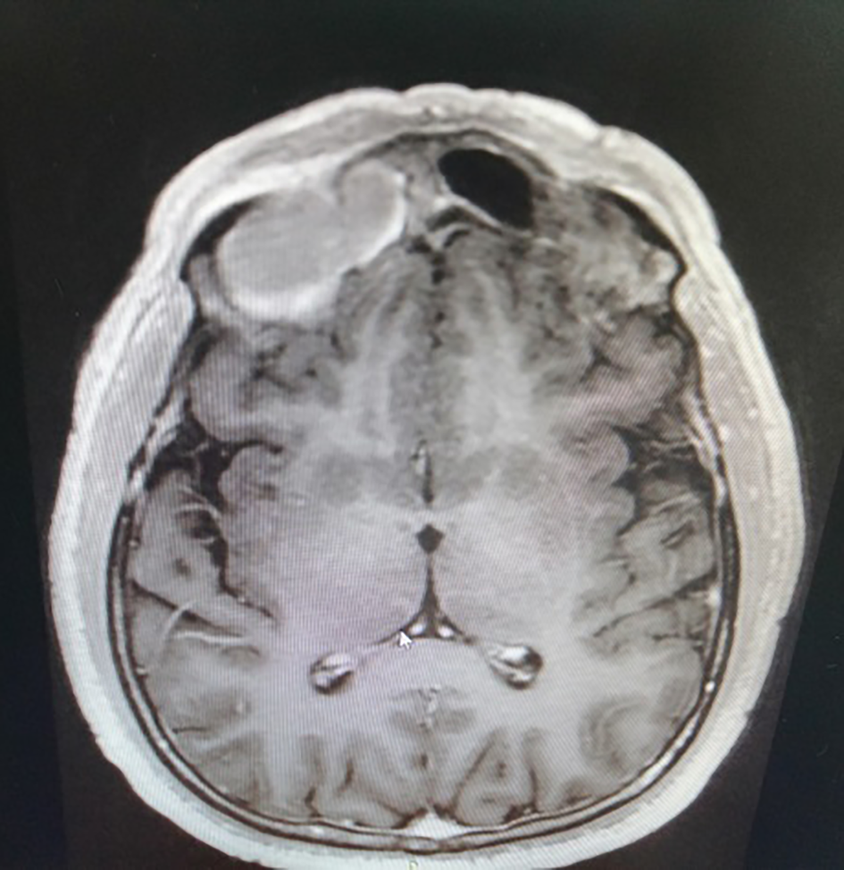 Acrylic bone cement with Tutopatch for frontal sinus obliteration | The ...