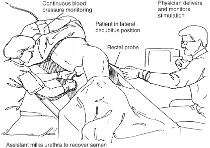 Abnormalities of ejaculation Chapter 26 Infertility in the Male