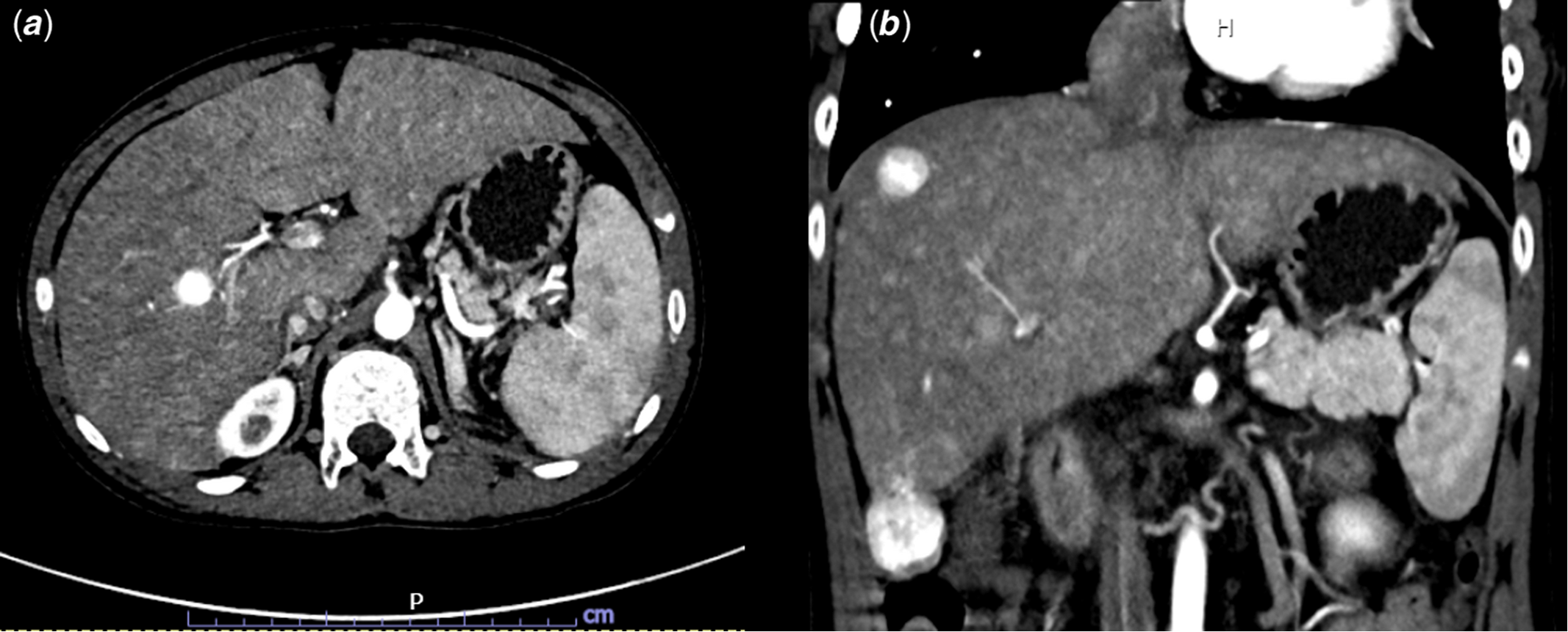 Liver nodules after the Fontan operation: role of the computerised ...