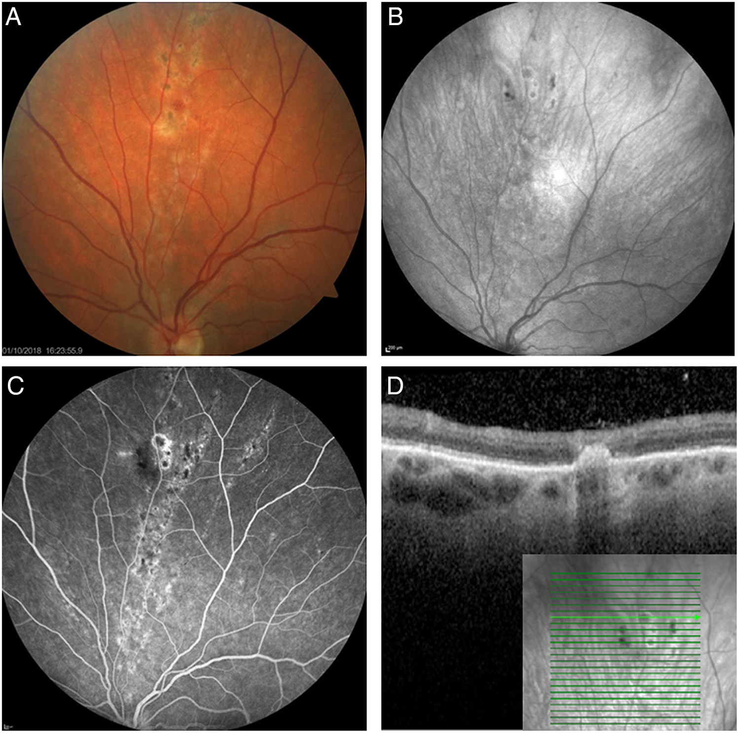 Chorioretinal Lesions in West Nile Virus Infection: Connecting the Dots ...