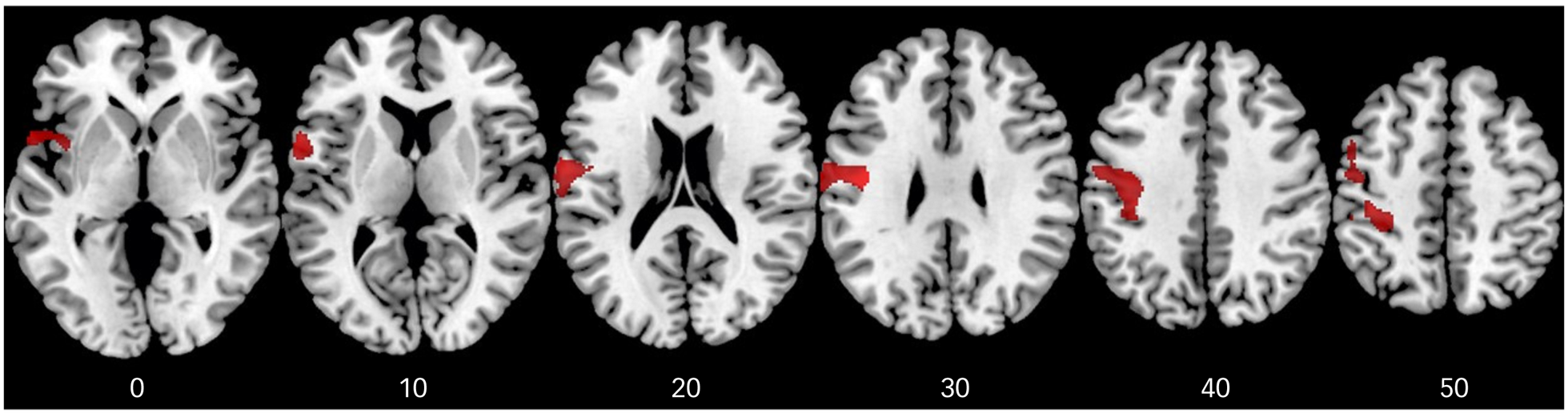 Examining the common and specific grey matter abnormalities in childhood  maltreatment and peer victimisation | BJPsych Open | Cambridge Core