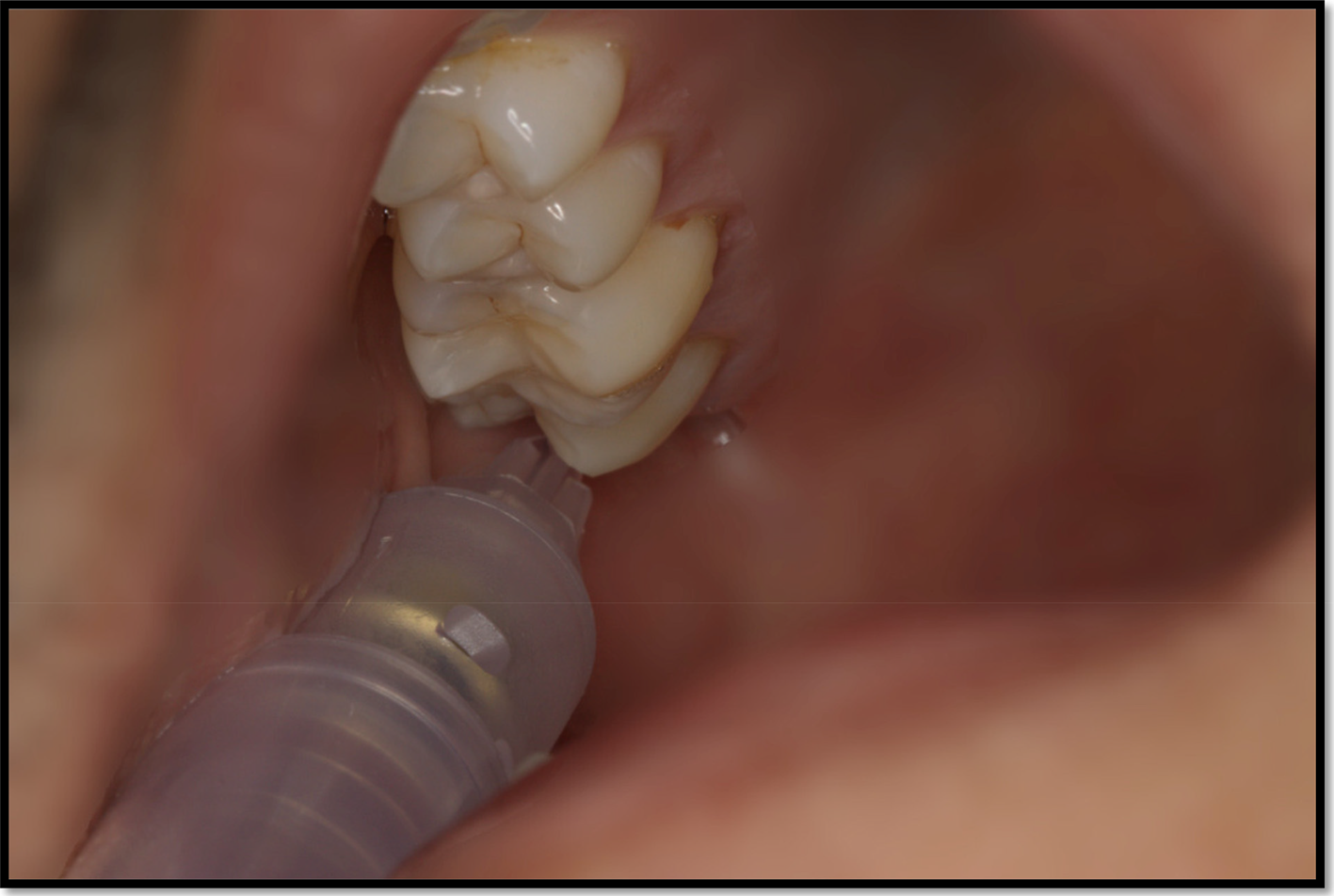 Local Anaesthetic Techniques In Endoscopic Sinonasal Surgery A Contemporaneous Review The 2927