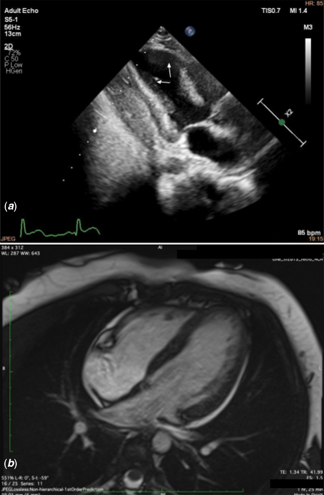 Figure 1: Clinical Course of LV Dysfunction in the Setting of Takotsubo  Cardiomyopathy