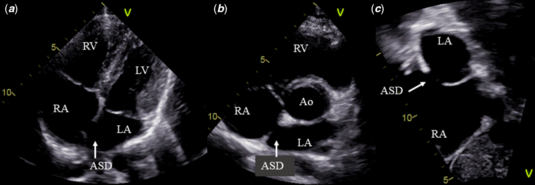 Crochetage' sign on ECG in secundum ASD: clinical significance