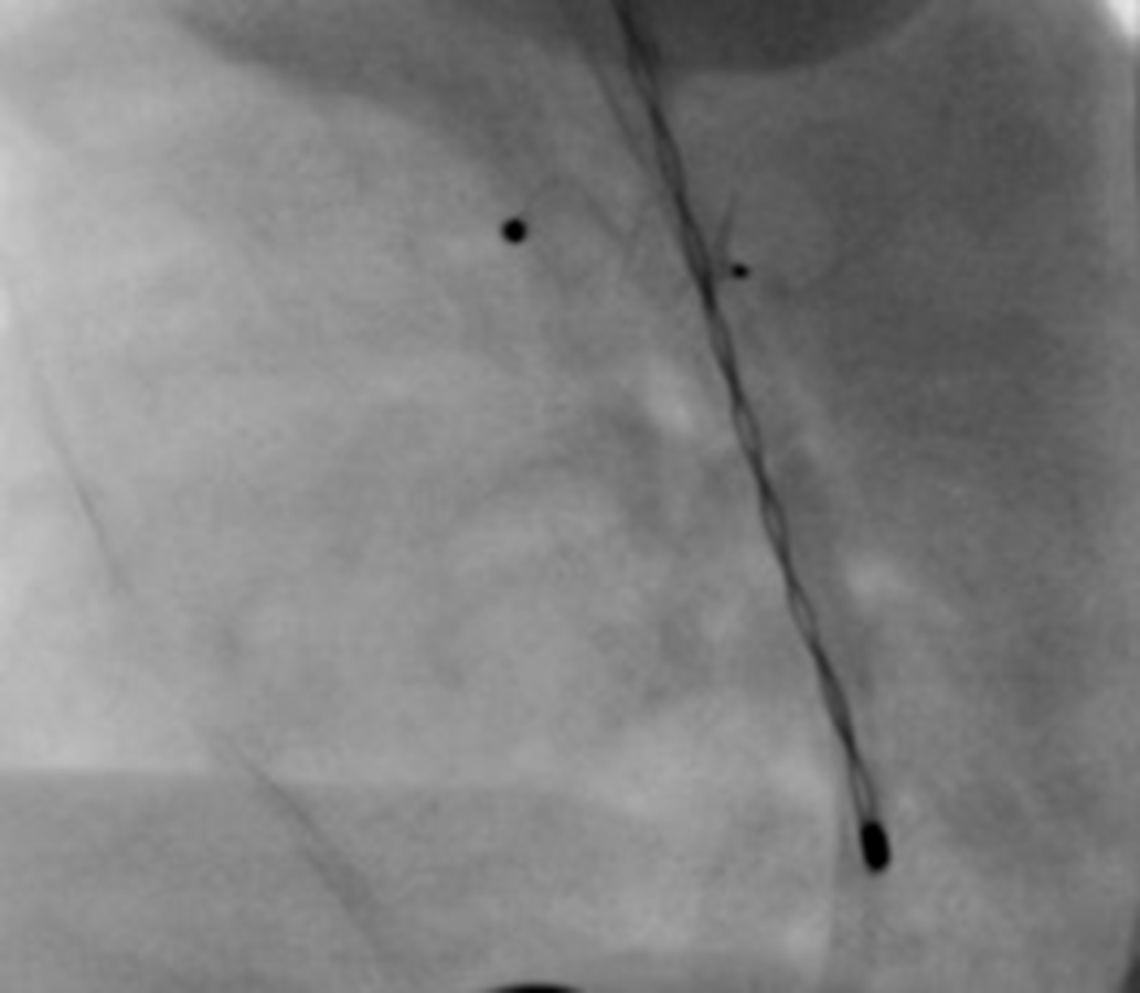 Aortic migration of Amplatzer Piccolo™ ductal Occluder Cardiology in