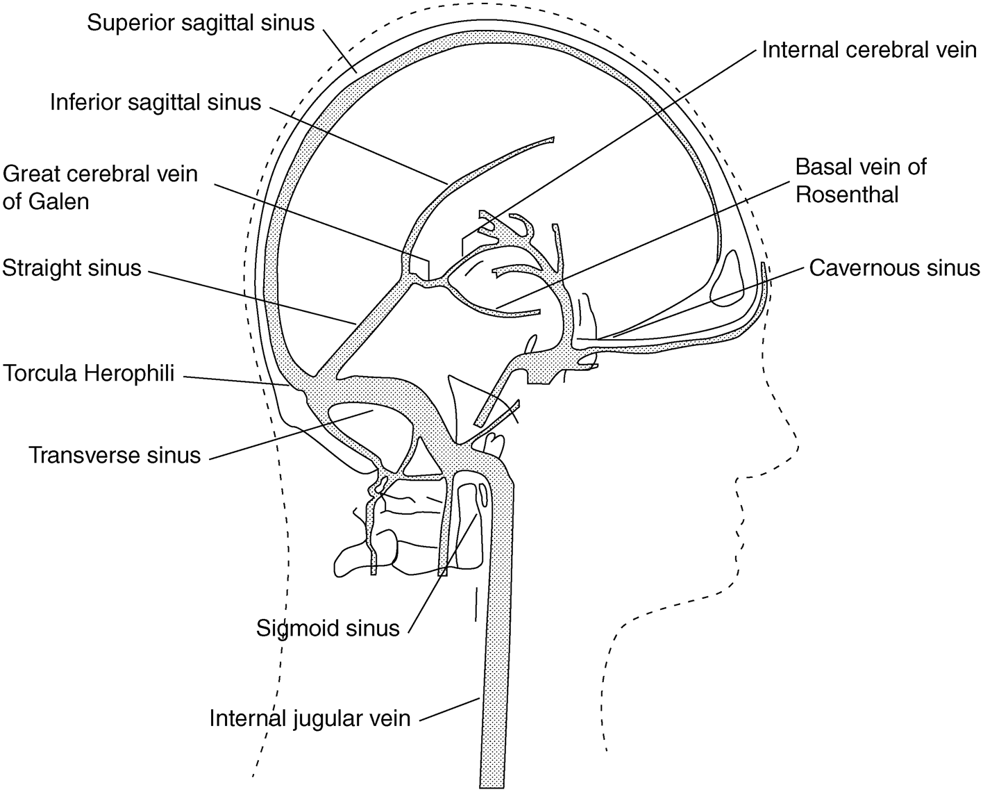 superior sagittal sinus thrombosis