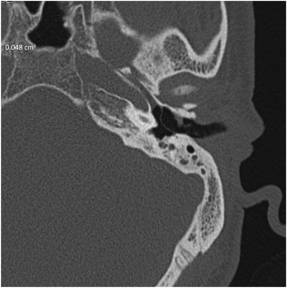 The relationship between dimensions of the Eustachian tube and acquired ...