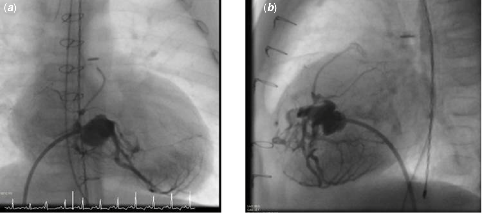 Very Preterm And Very Low Birthweight Infant With Pulmonary Atresia 