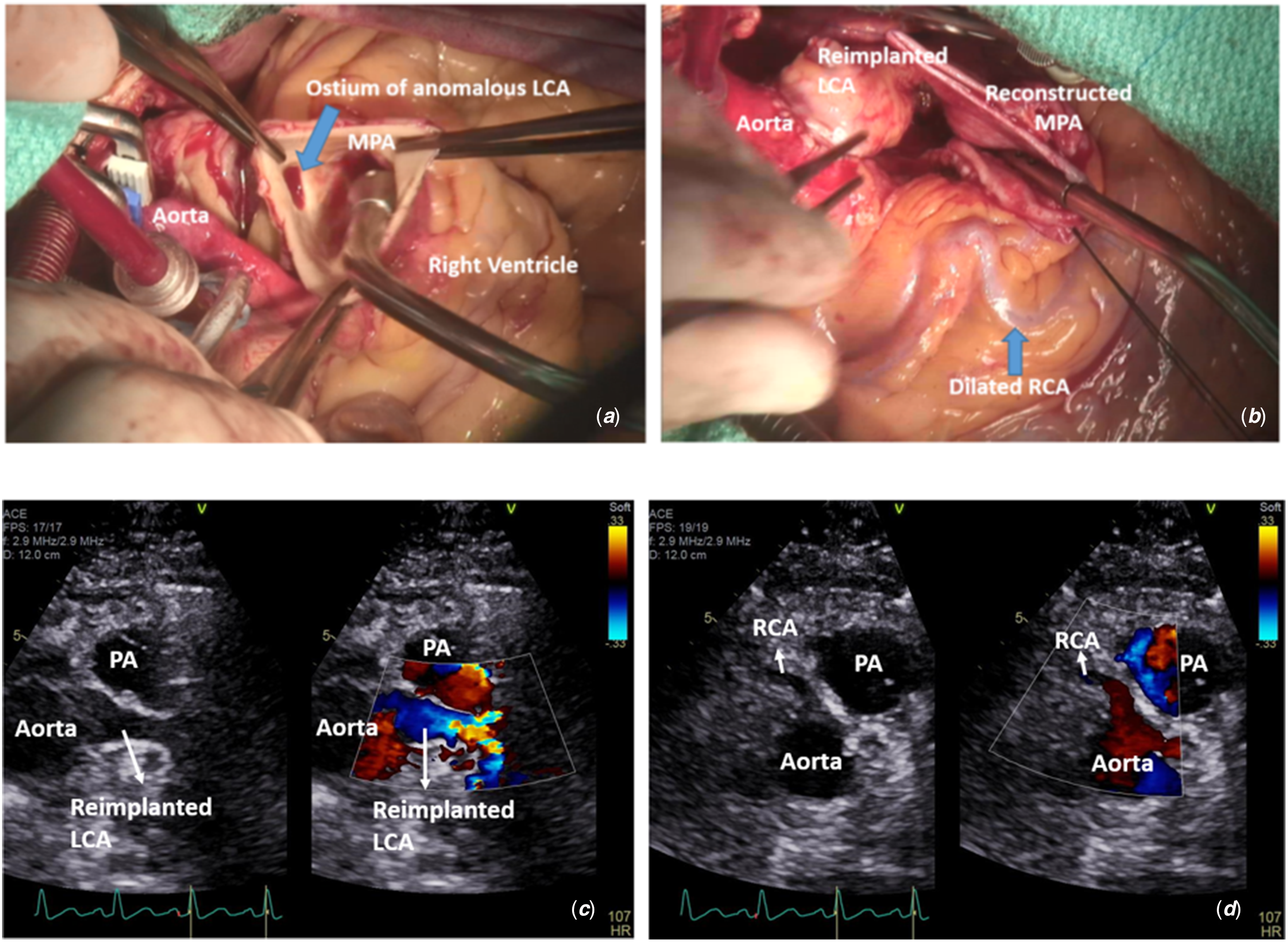 left pulmonary artery