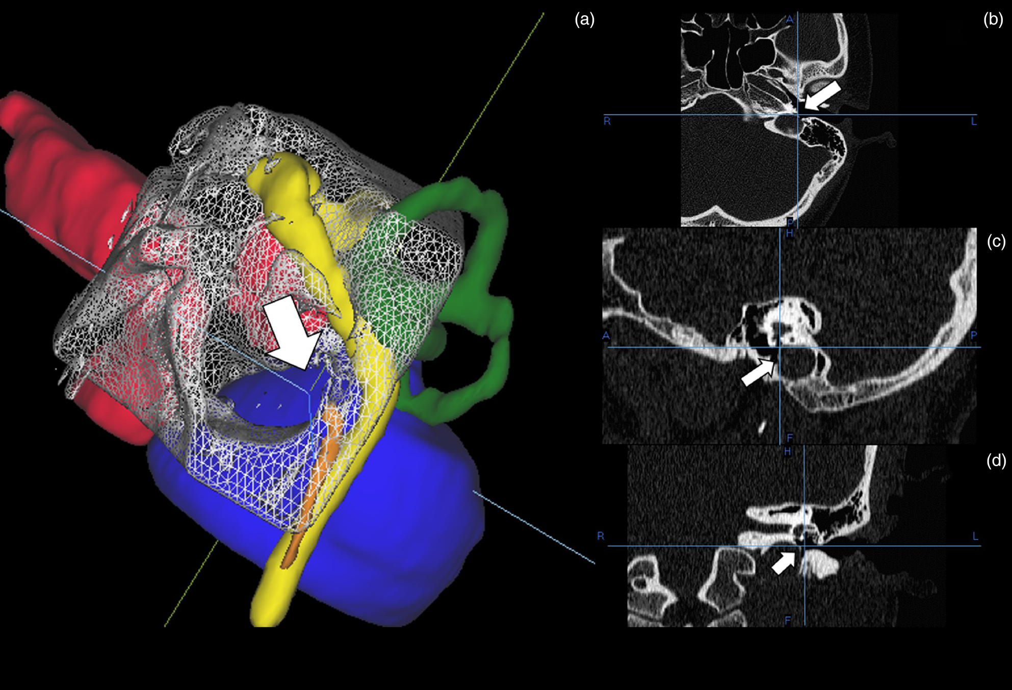 Radiological Evaluation Of Temporal Bone Surgical Landmarks For A Transcanal Transpromontorial 0051