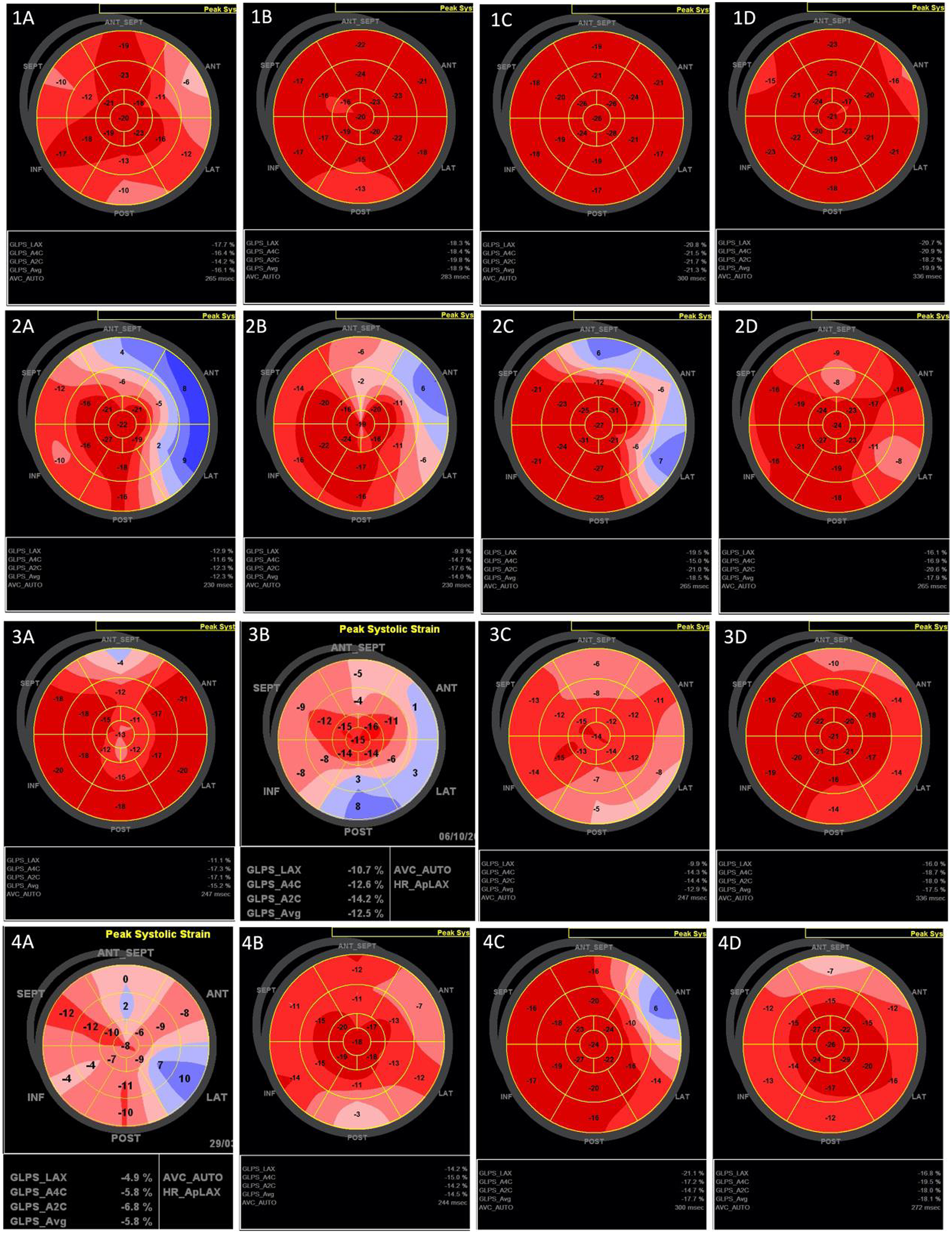 Bull's eye of global longitudinal strain of normal child.