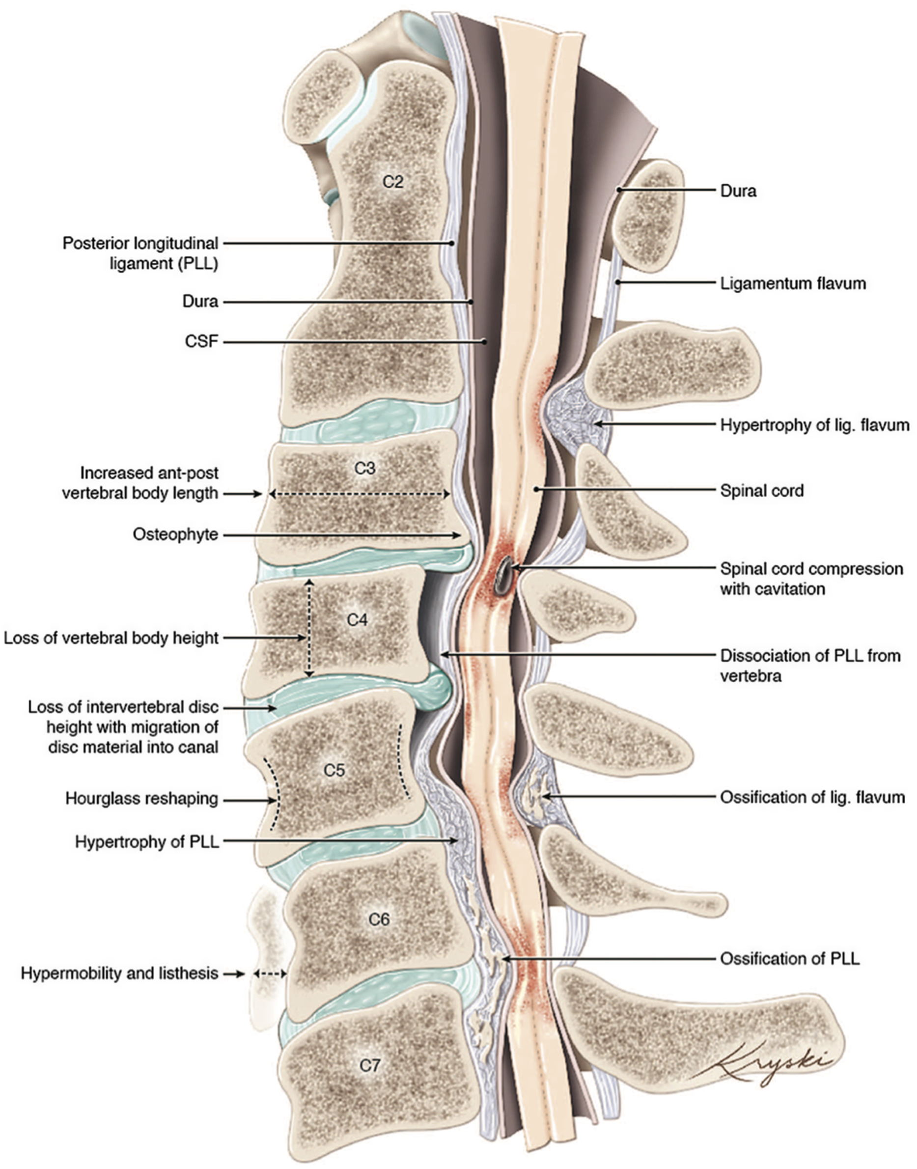 Spine anatomy and effects of spinal degeneration disease