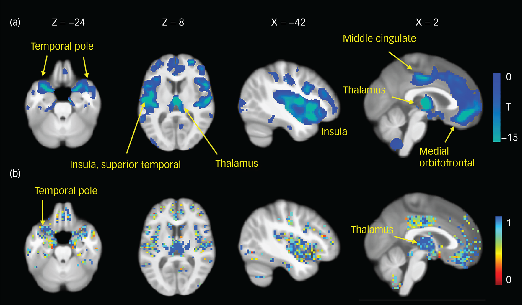 Large-scale analysis of structural brain asymmetries in schizophrenia via  the ENIGMA consortium