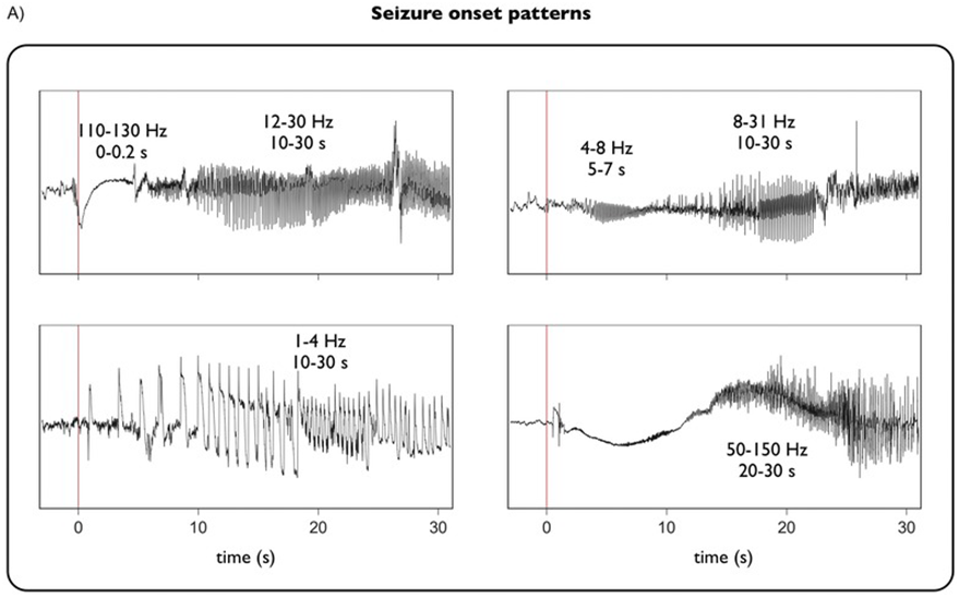 EEG detection systems. 1-1: major components of the seizure advisory