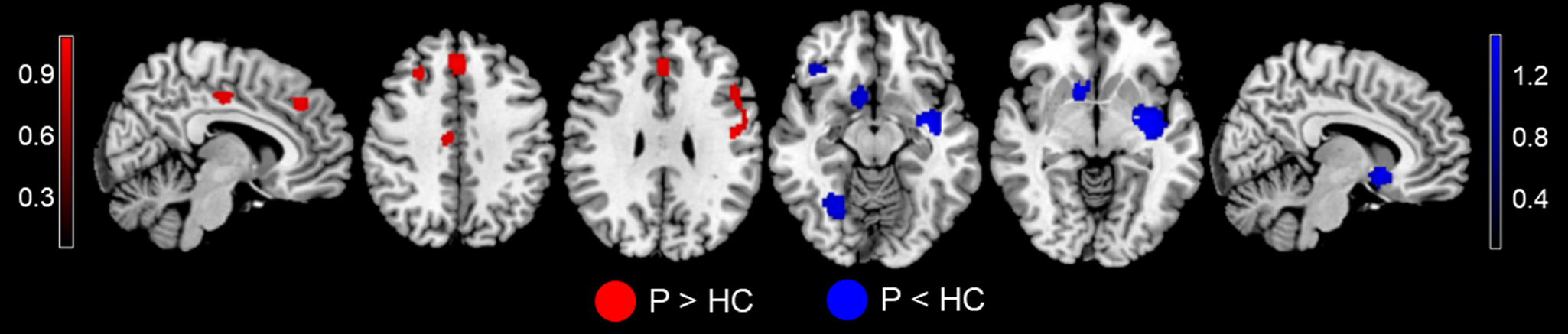 Neurofunctional Mapping Of Reward Anticipation And Outcome For Major Neurofunctional Mapping Of Reward Anticipation And Outcome For Major