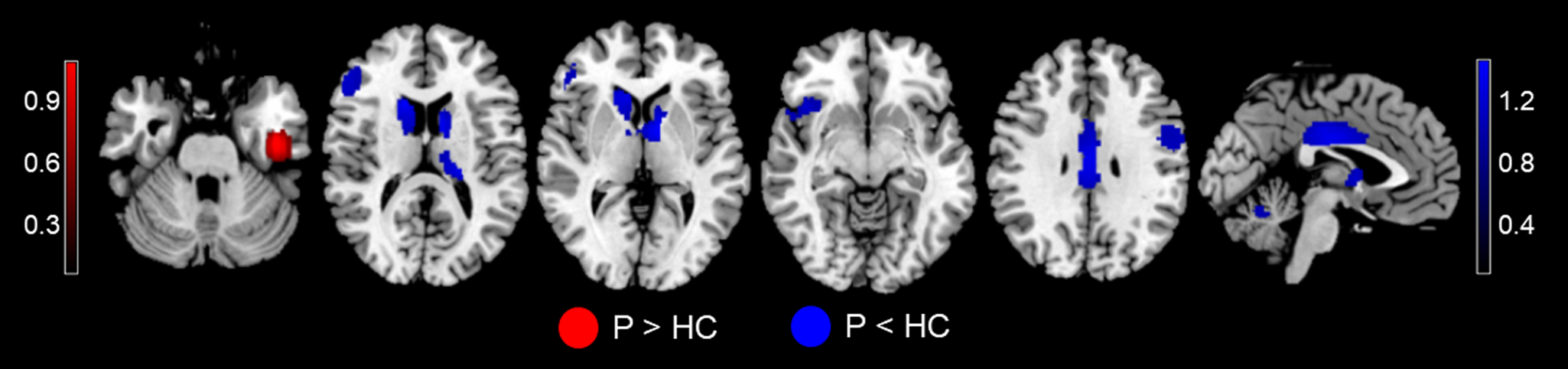 Neurofunctional Mapping Of Reward Anticipation And Outcome For Major Neurofunctional Mapping Of Reward Anticipation And Outcome For Major