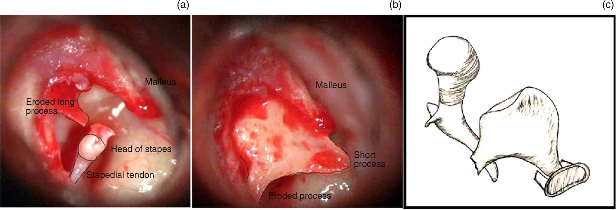 Artwork Of Prosthetic Stapes In Middle Ear Photograph by John