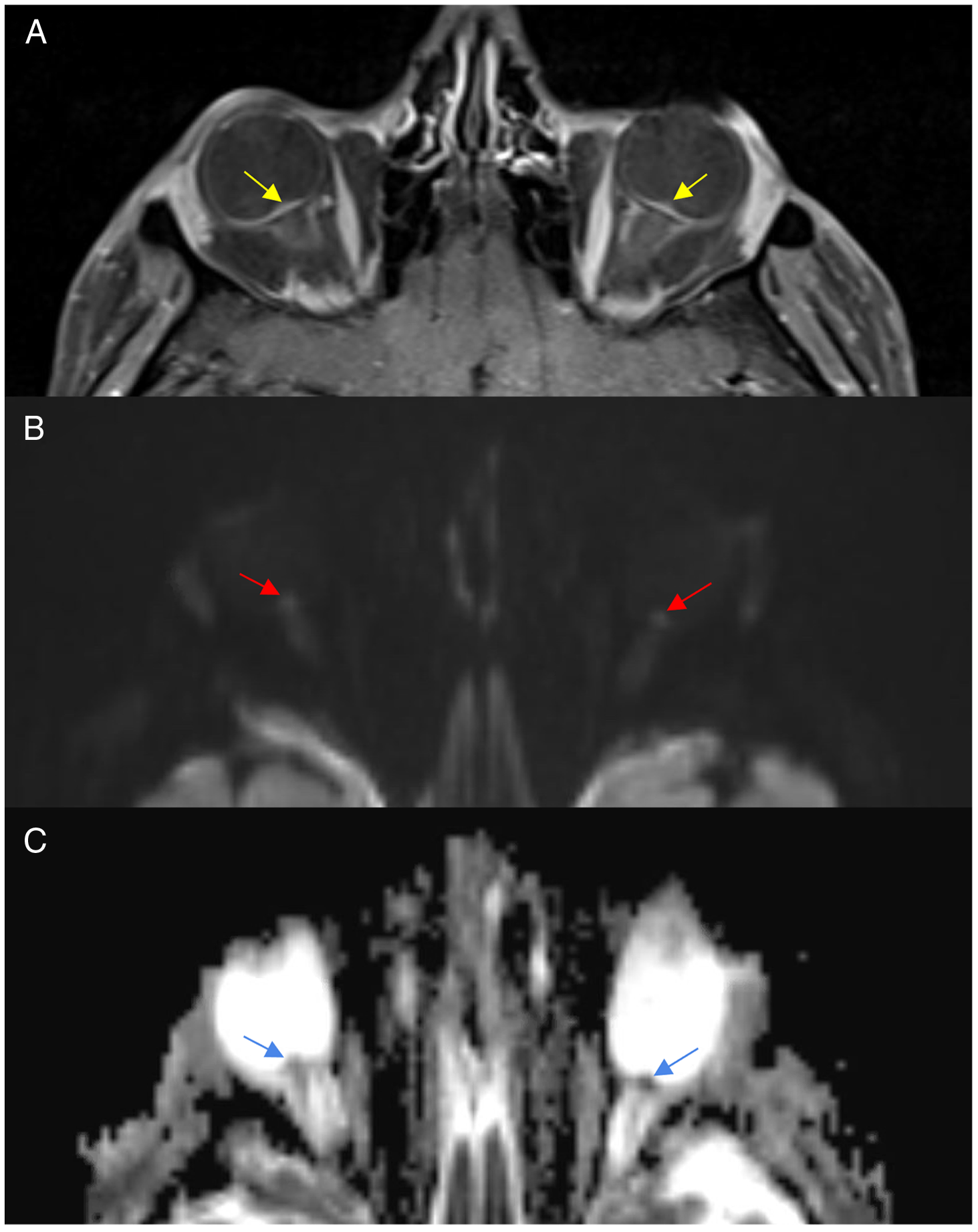MRI on Jays' Dickey reveals minor inflammation