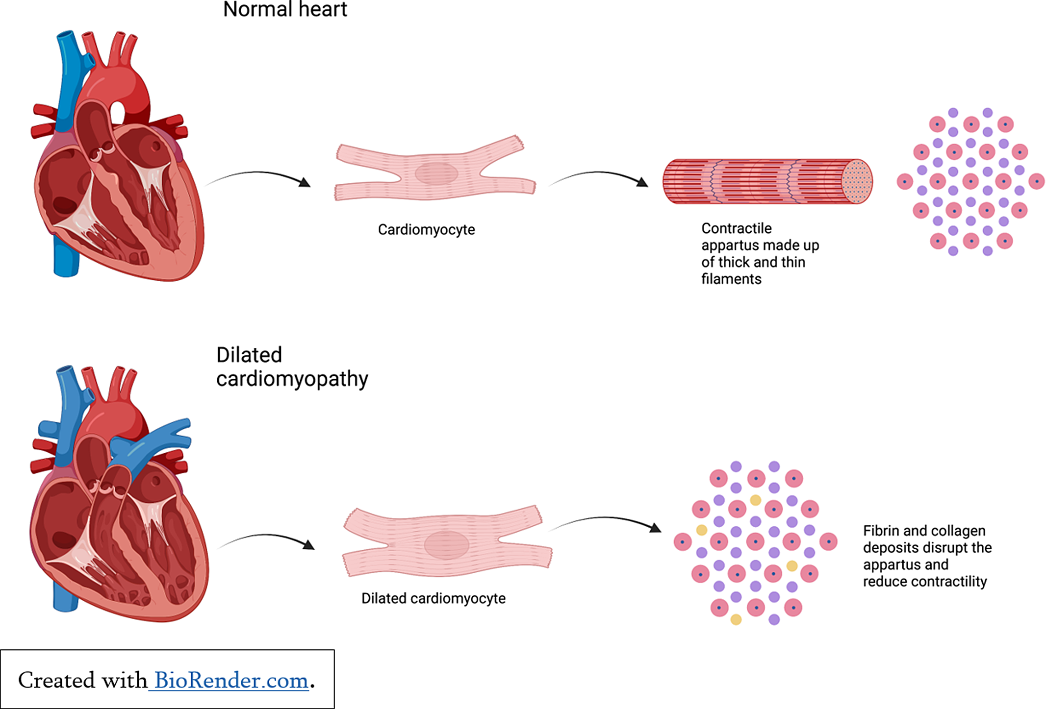 Paediatric heart failure – understanding the pathophysiology and the ...