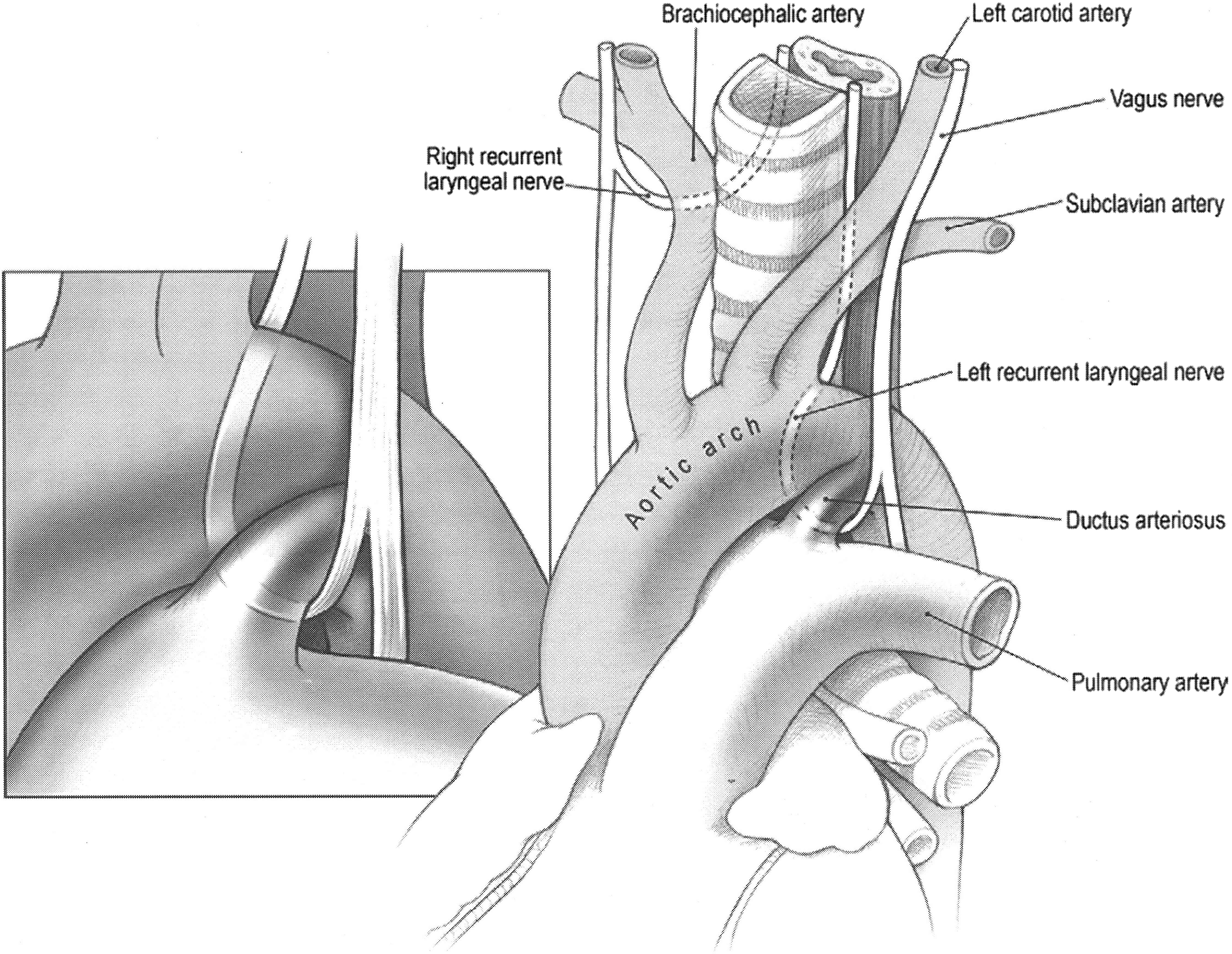 recurrent laryngeal nerve