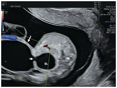 A) A B-mode ultrasound image of a bladder in a transverse section