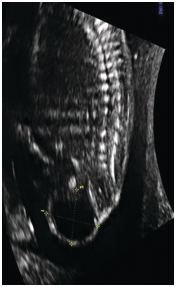 Ultrasound images • Fetal spine, B-mode, echogramm №40