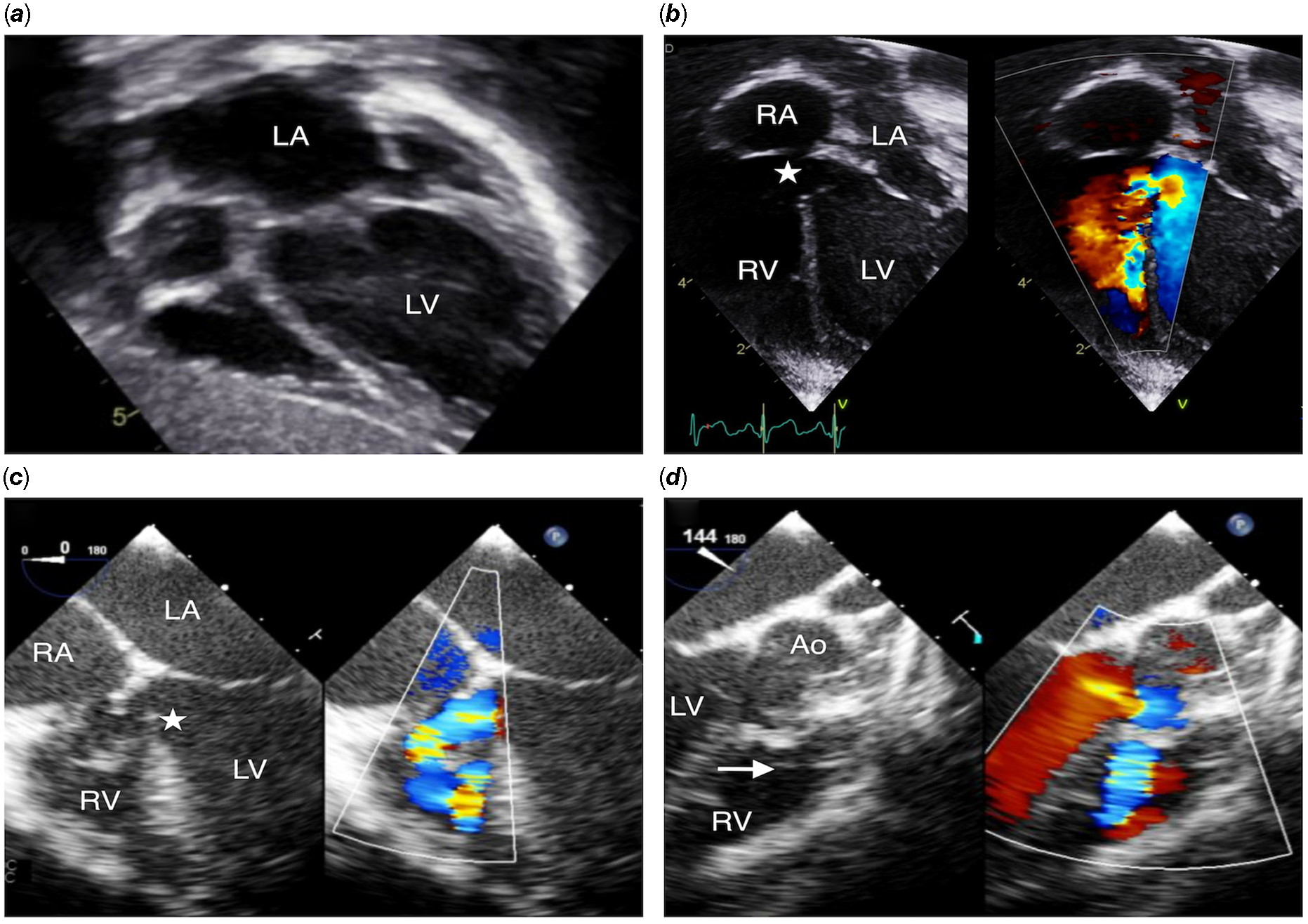 Transcatheter closure of large perimembranous ventricular septal ...