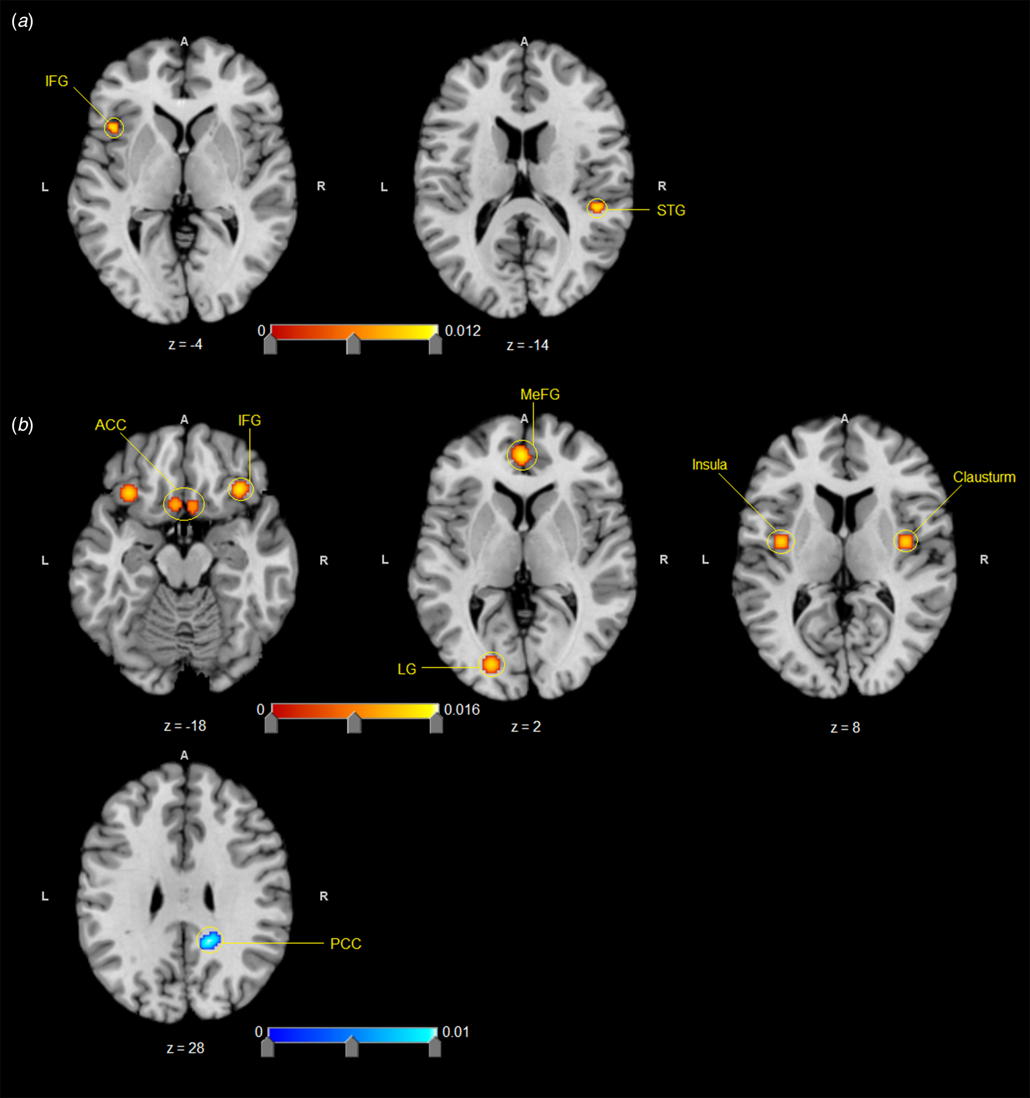 Key Brain Activity Absent in Borderline Personality Disorder - Neuroscience  News