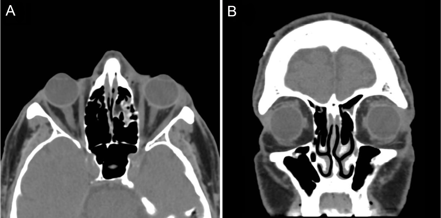 Acute Neuroimaging Findings in Traumatic Optic Neuropathy | Canadian ...