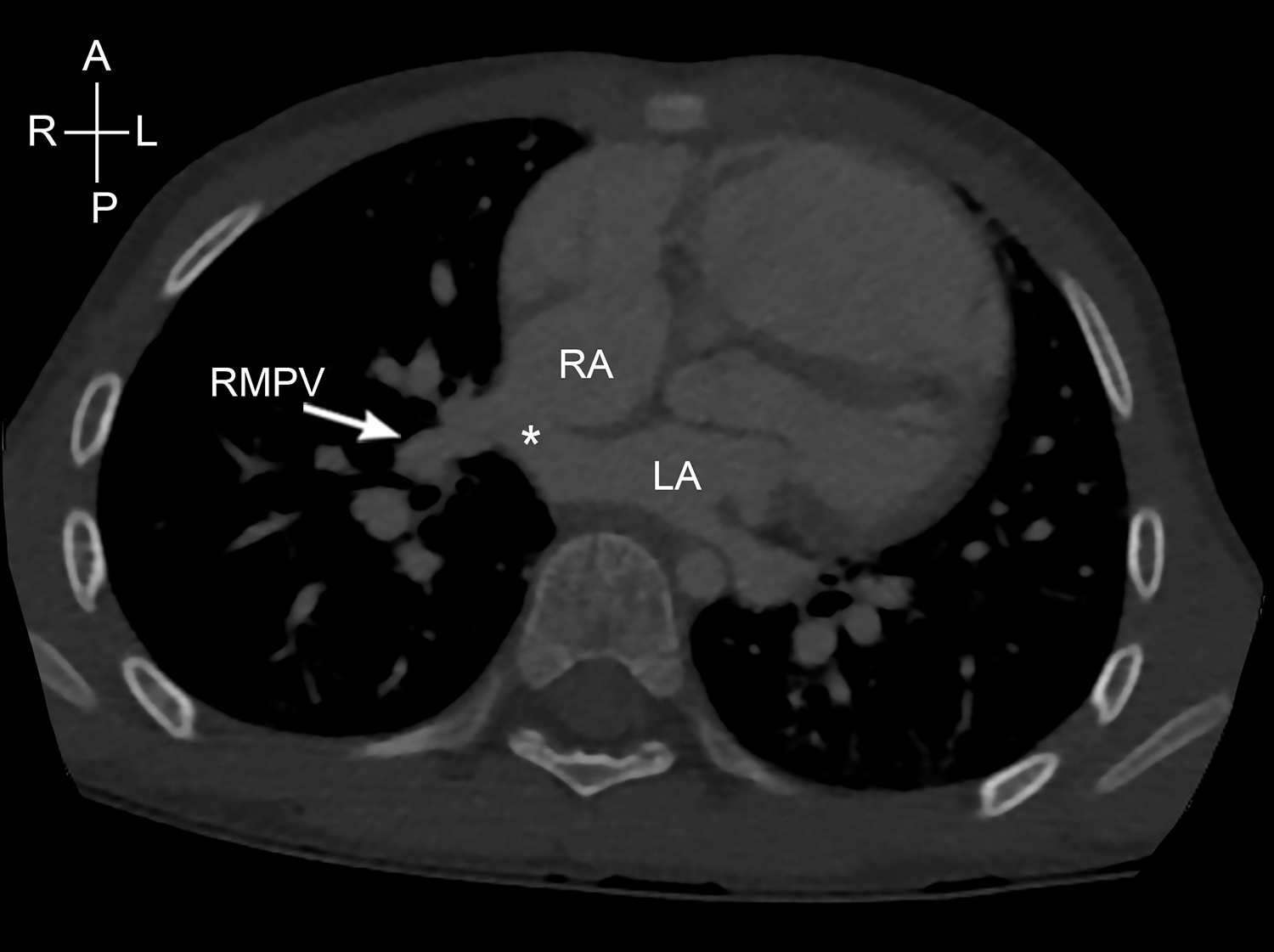 Multimodality imaging in delineation of complex sinus venosus defects and  treatment outcomes over the last decade | Cardiology in the Young |  Cambridge Core